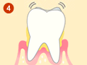 歯周病の進行 流れ4